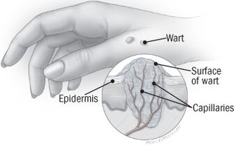 The structure of warts on the hands