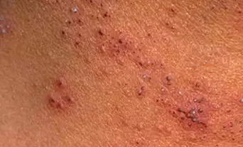 various papillomas on the skin