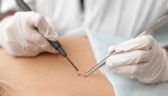 Features -Papilloma Removal Features