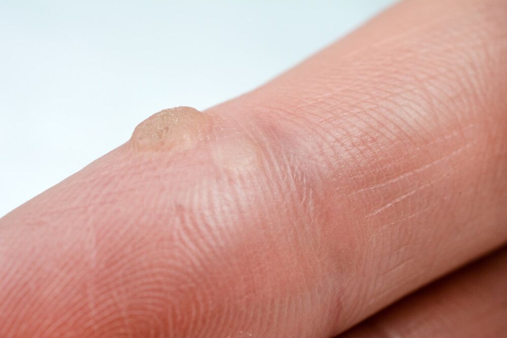wart
