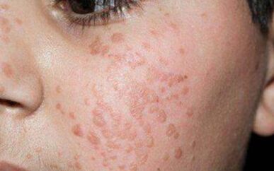 A flat papilloma in the face