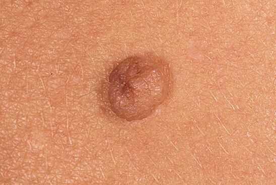 Papilloma is simple