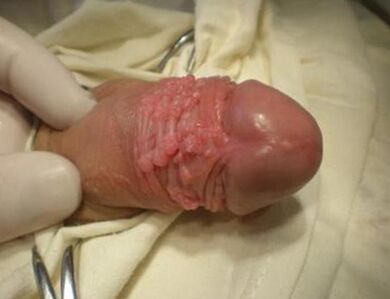 Papilloma on members