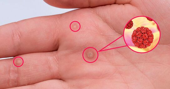 The defeat of the palm of the papilloma