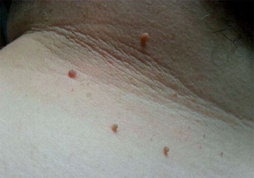 Papillomas in the neck
