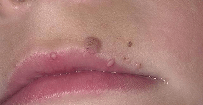 Papillomas on the lips
