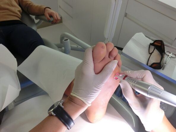 when you want to get rid of warts