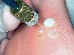 cryodestruction as a plantar wart removal method